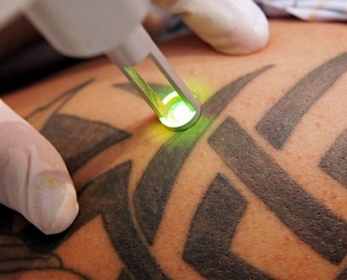 Αφαίρεση Τατουάζ Με Χρήση Laser