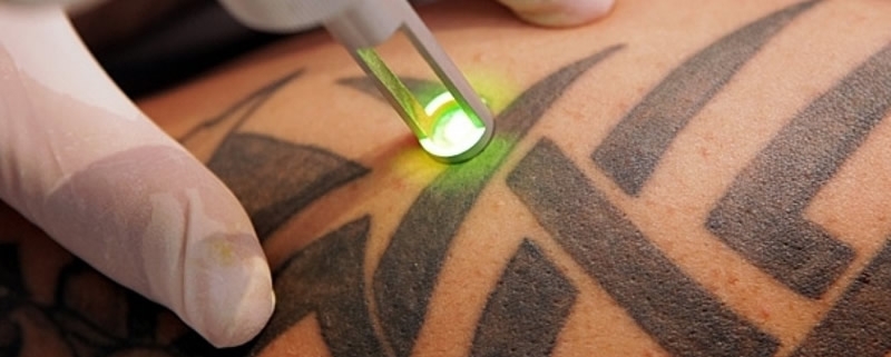 Αφαίρεση Τατουάζ Με Χρήση Laser